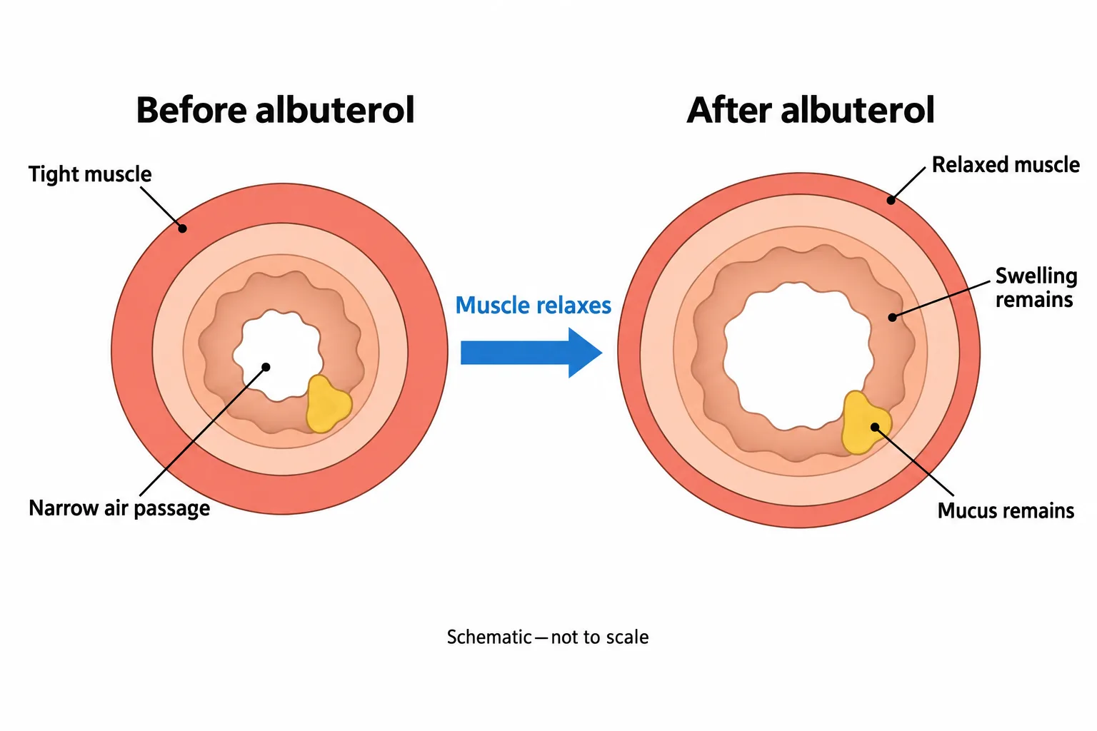 Paired airway cross-sections show albuterol relaxing the surrounding muscle and widening the passage while swelling and mucus remain.