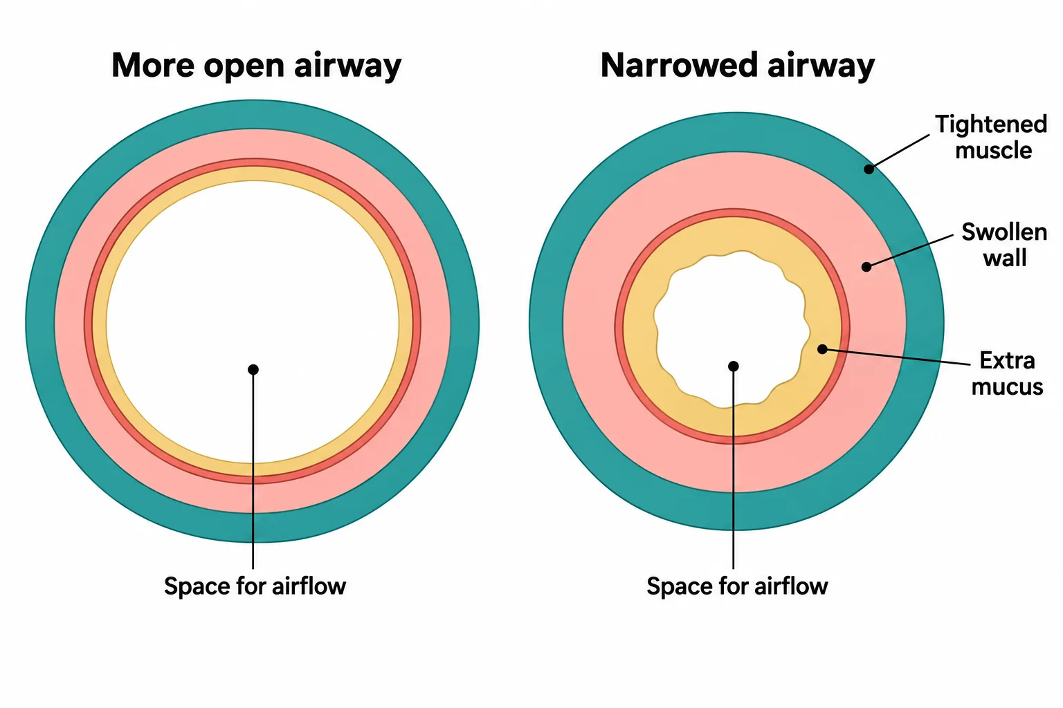 Matched airway cross-sections show how swelling, extra mucus, and tightened muscle reduce the space available for airflow.