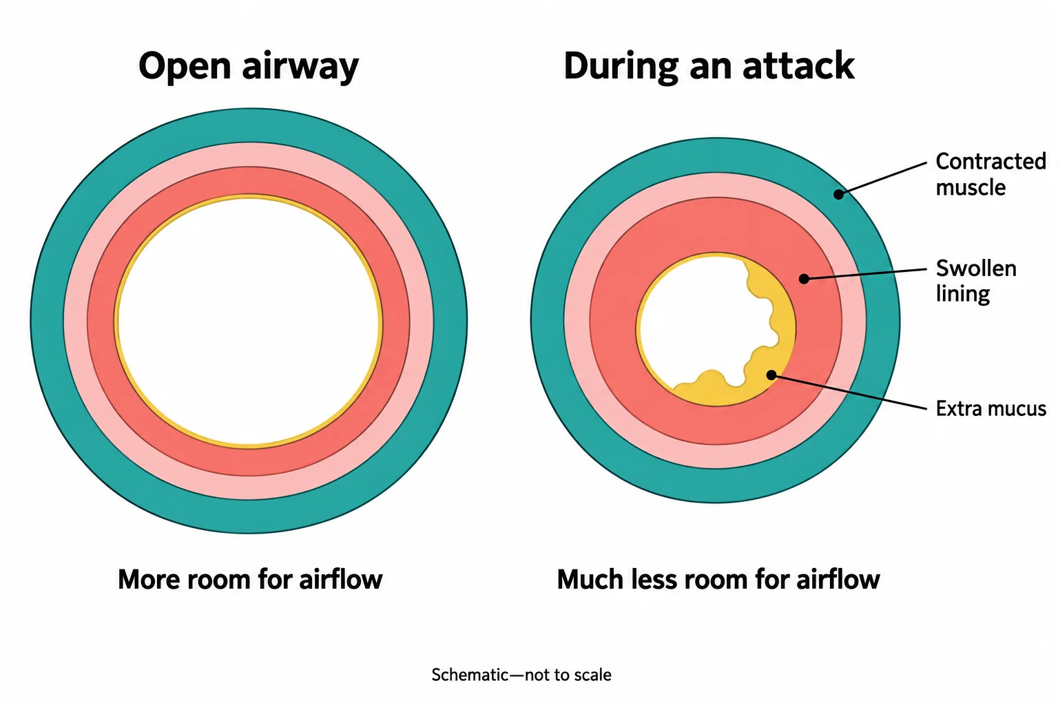 Side-by-side airway cross-sections show how contracted muscle, swollen lining, and mucus combine to shrink the opening.