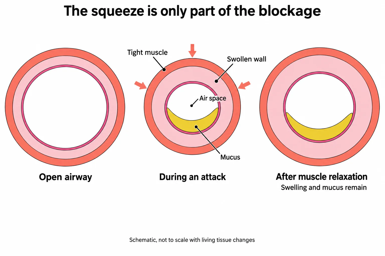 Three airway cross-sections show an open airway, combined obstruction during an attack, and partial reopening after muscle relaxation while swelling and mucus remain.
